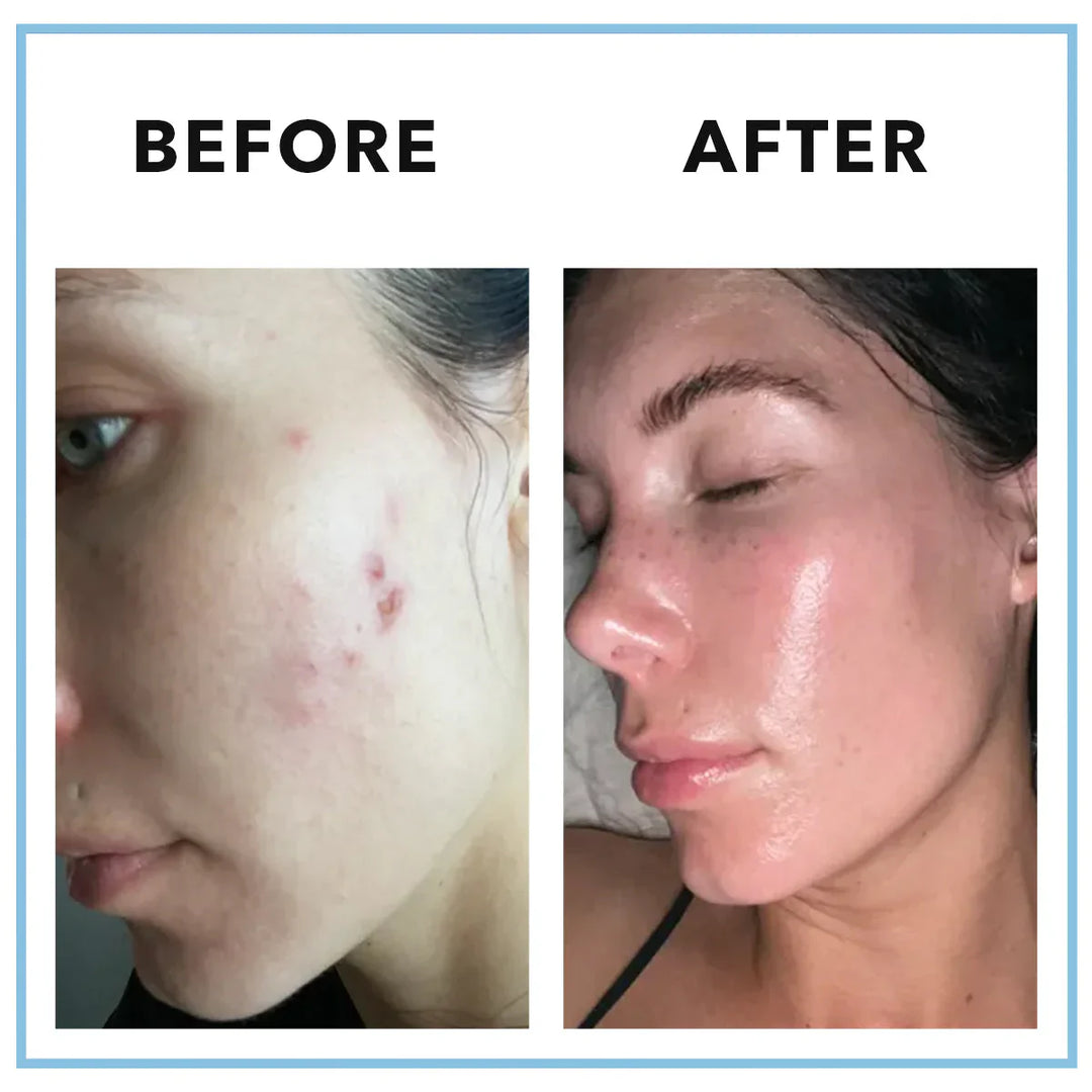 Clearstem | MINDBODYSKIN® Hormonal Acne Supplement